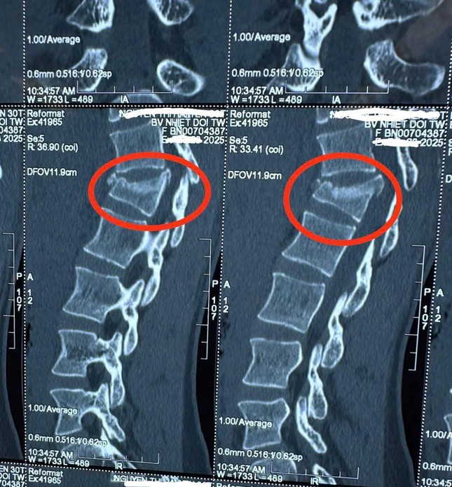 Phẫu thuật bắt vít vào cột sống giúp người phụ nữ liệt hoàn toàn đi lại bình thường ảnh 2