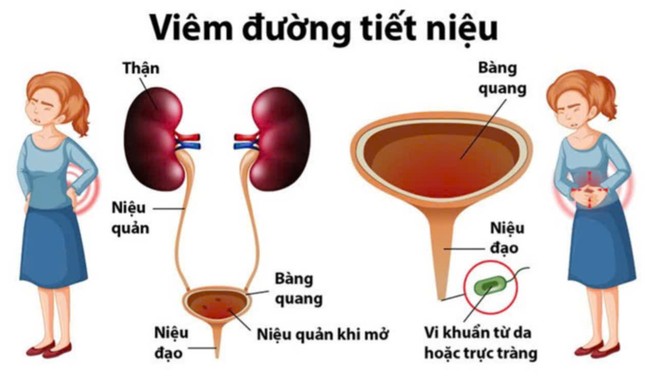 Chị em đừng bỏ qua những dấu hiệu &apos;đơn giản&apos; này kẻo nhiễm trùng máu, hỏng thận ảnh 2