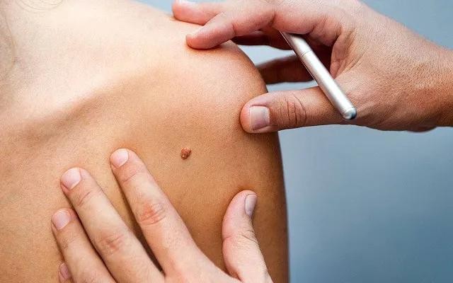 Người phụ nữ hoảng hốt khi biết mắc ung thư, dấu hiệu chỉ là một chấm &apos;bé như đầu tăm&apos; trên da ảnh 1