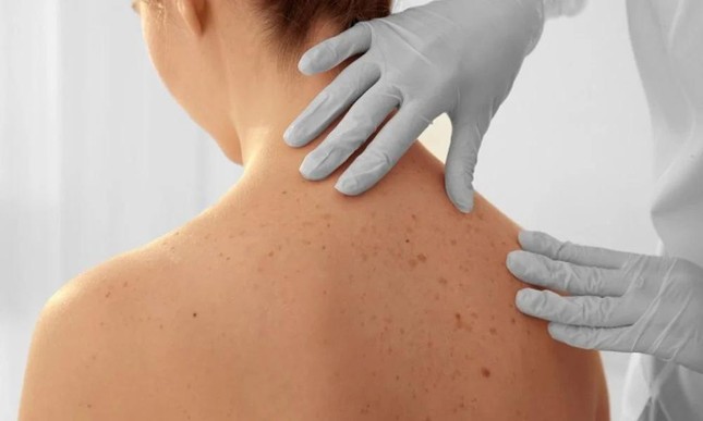 Người phụ nữ hoảng hốt khi biết mắc ung thư, dấu hiệu chỉ là một chấm &apos;bé như đầu tăm&apos; trên da ảnh 2