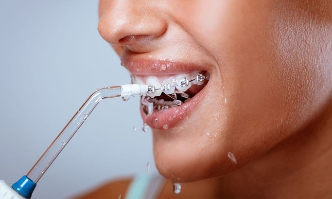 Cách chăm sóc răng miệng khi niềng răng để khỏi 'tiền mất tật mang', không phải ai cũng biết ảnh 1