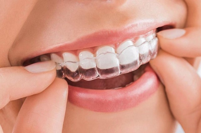 Cách chăm sóc răng miệng khi niềng răng để khỏi 'tiền mất tật mang', không phải ai cũng biết ảnh 3