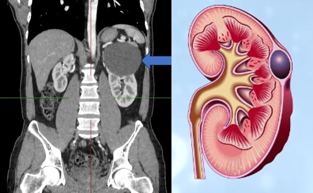 Bác sĩ chuyên khoa nói về căn bệnh cực kỳ &apos;phiền toái&apos;, đàn ông mắc nhiều gấp đôi phụ nữ ảnh 2