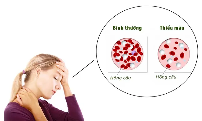 6 dấu hiệu cảnh báo bệnh nguy hiểm về máu, đừng chủ quan vì dễ nhầm với... &apos;bệnh vặt&apos; ảnh 4