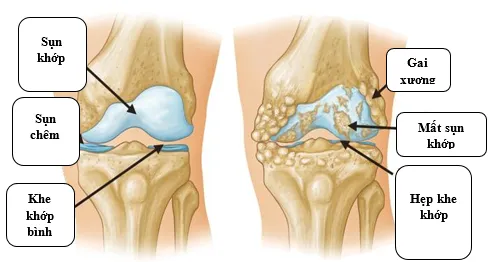 Đau khớp gối - Những điều cần biết để điều trị kịp thời, tránh tàn phế ảnh 2