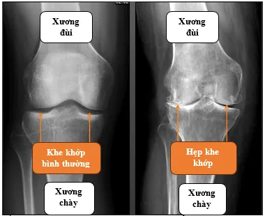 Đau khớp gối - Những điều cần biết để điều trị kịp thời, tránh tàn phế ảnh 3