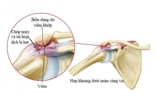 Những bệnh lý khớp vai cần đặc biệt chú ý để không... tàn phế ảnh 2