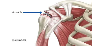 Những bệnh lý khớp vai cần đặc biệt chú ý để không... tàn phế ảnh 3