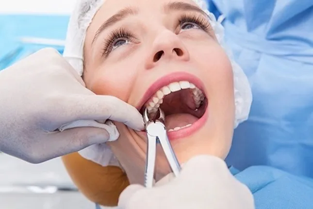 Răng khôn &apos;mọc dại&apos;: Khi nào thì bắt buộc phải nhổ? ảnh 2