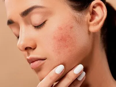 Tẩy tế bào chết vật lý hay hóa học, chọn cách nào để “tiến hóa” hành trình skincare? ảnh 3