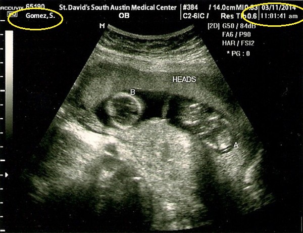 Selena Gomez has a headache because of pregnancy rumors with Justin Bieber photo 1