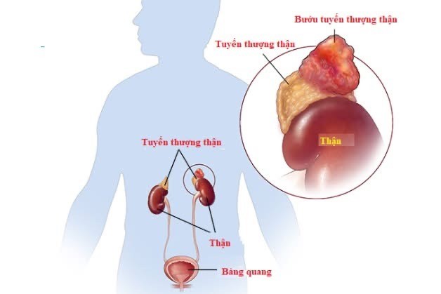 Nguy cơ từ u tuyến thượng thận: Người trẻ tăng huyết áp không rõ nguyên nhân cần cảnh giác ảnh 2