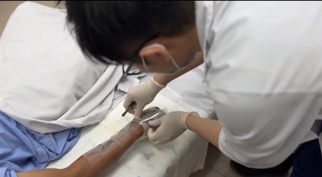 Bỏng điện phá huỷ từ bên trong: Cảnh báo hậu quả khó lường từ ca bệnh của nạn nhân 37 tuổi ảnh 2