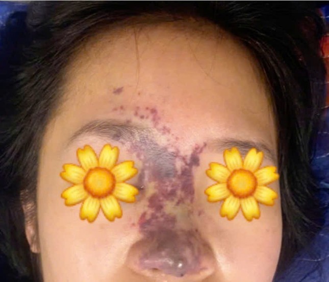 Bệnh viện Bạch Mai liên tiếp nhận ca biến chứng thẩm mĩ do spa không phép gây họa ảnh 2