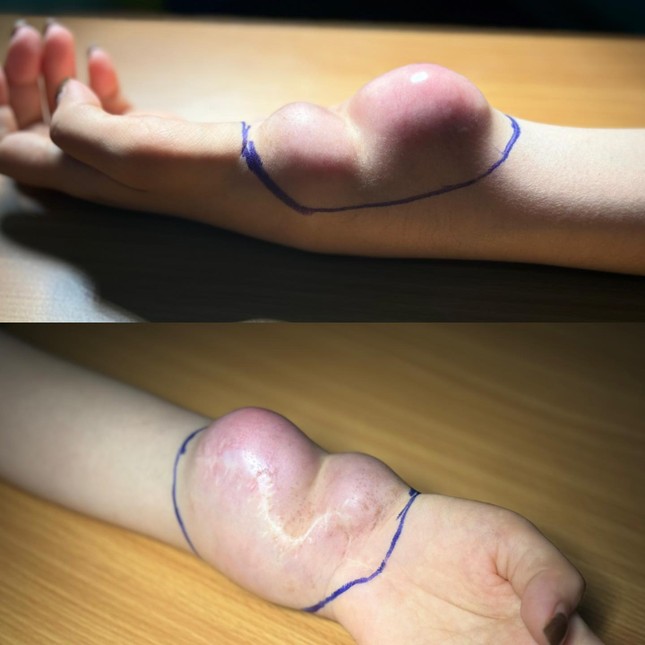 Bị chẩn đoán nhầm suốt 9 năm, cô gái suýt mất đôi tay vì bệnh ung thư hiếm gặp ảnh 1