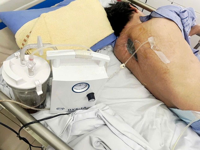 Phát hiện nhiễm nấm tại vết mổ: Nguyên nhân bất ngờ khiến bệnh nhân liệt hai chân ảnh 1