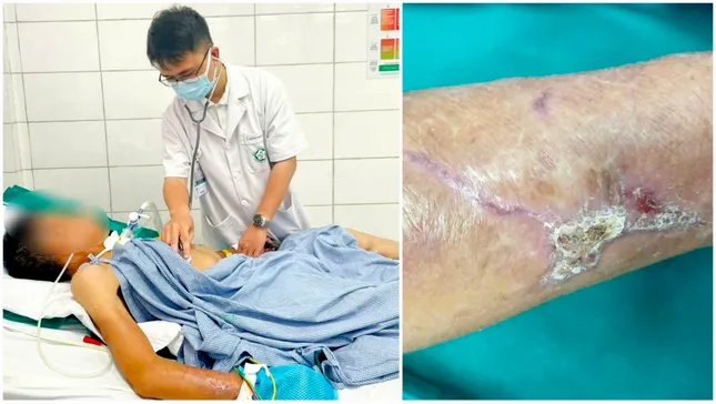 Cứng hàm, suy hô hấp vì vết xước nhỏ, cảnh báo 'đặc biệt' từ hai ca uốn ván nặng ảnh 2