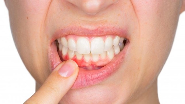 Lười đánh răng dẫn đến những tác hại khôn lường ảnh 5