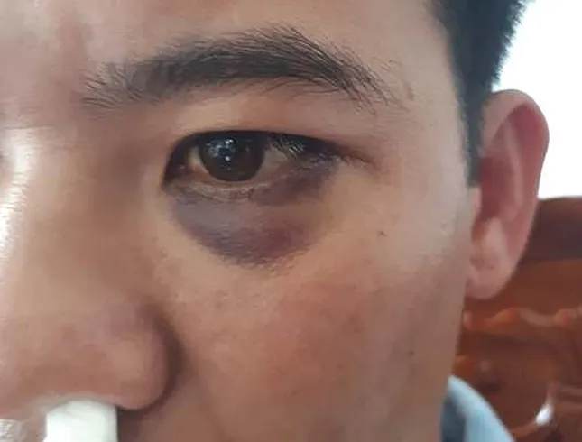 Học sinh dẫn người lạ vào trường đánh thầy giáo gãy xương mũi ảnh 3