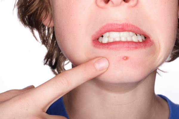 Khoa học chứng minh: Người bị mụn trứng cá thường có điểm số cao và thành công ảnh 1