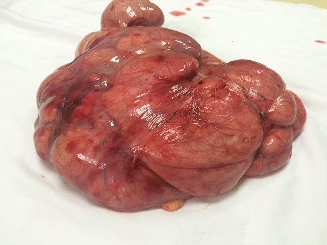 Phẫu thuật thành công lấy khối u nặng 5kg trong ổ bụng nữ bệnh nhân - ảnh 1