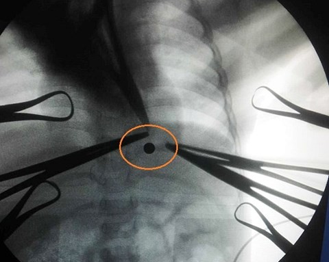 Bé 16 tháng tuổi rách màng phổi vì trúng đạn bi xe đạp - ảnh 2