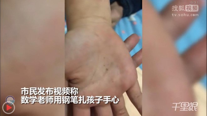 Học sinh tiểu học bị đâm bút chì vào tay khi làm sai bài - ảnh 1