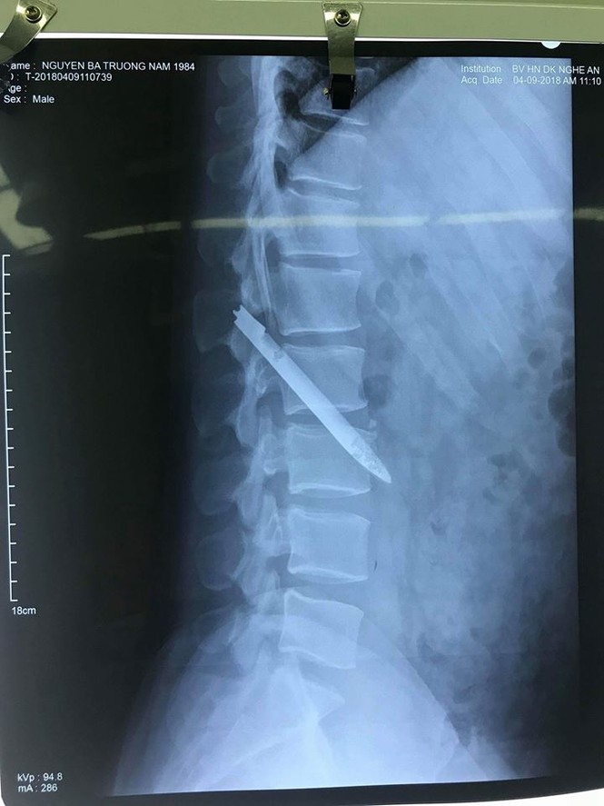 Phẫu thuật lấy lưỡi dao găm 11 năm trong cơ thể chiến sỹ công an - ảnh 1