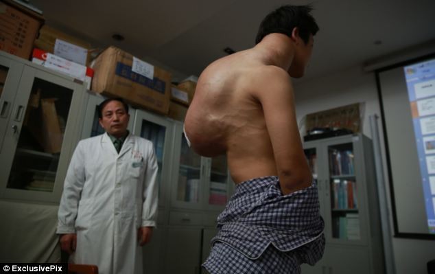Trung Quốc: Người có khối u 10 kg tái phát sau một lần mổ - ảnh 1