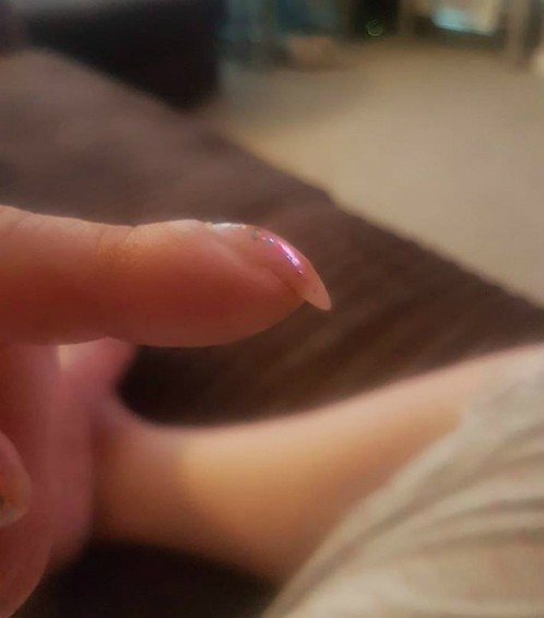 Móng tay quặp cảnh báo ung thư phổi - ảnh 1