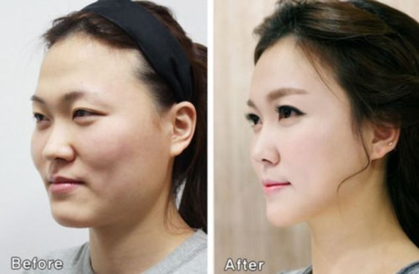 Dở khóc dở cười với các cô nàng 'vịt hóa thiên nga' sau thẩm mỹ - ảnh 1