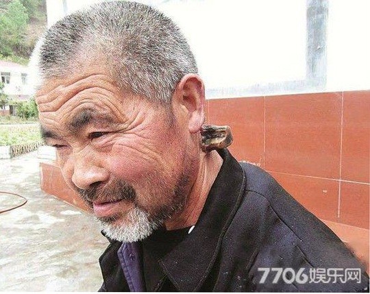 Người đàn ông mọc sừng ở gáy - ảnh 1