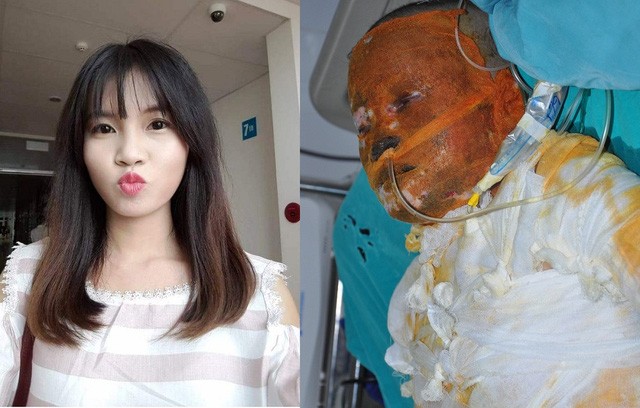 Nữ sinh gặp tai nạn bỏng xăng kinh hoàng - ảnh 1