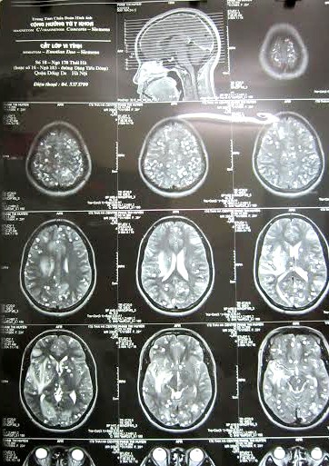 Ăn nem thính bị sán lợn làm tổ trong não - ảnh 1