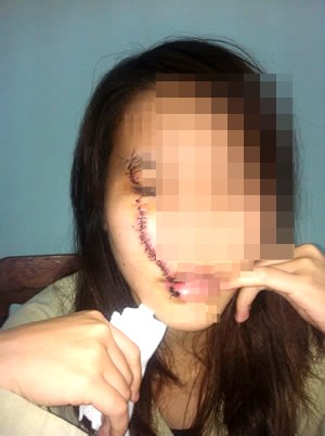 Cô gái bị nữ sinh 16 tuổi rạch mặt giữa đường - ảnh 1