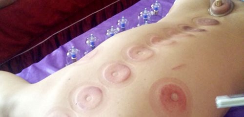 Giác hơi 7 phút phán 'bá bệnh' - ảnh 3