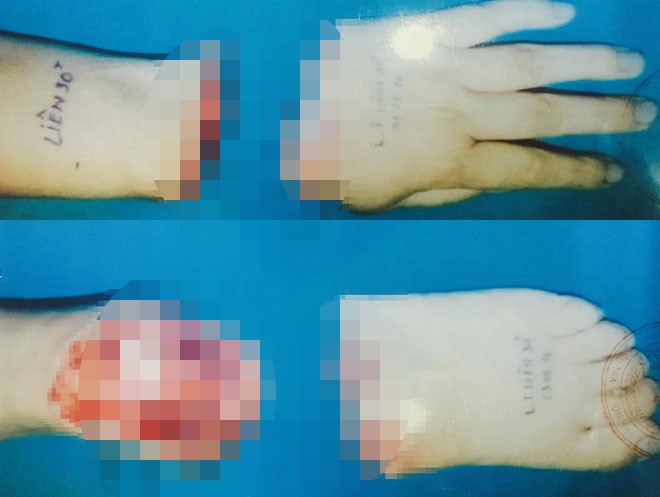 Lời khai của người đàn bà thuê chặt chân, tay để trục lợi bảo hiểm - ảnh 2