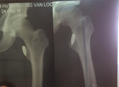 Vận động viên võ thuật bị đạn găm trúng đùi khi đi xe máy - ảnh 2