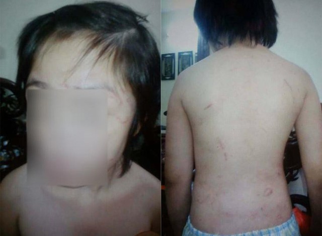 Bé trai bị bố đánh gãy xương, rạn sọ: Giảm 20kg vì bị bạo hành - ảnh 1