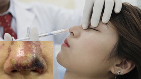 Tiêm filler: Sau công dụng 'thần tiên', làm nhanh giá rẻ là ẩn họa khôn lường! - ảnh 2