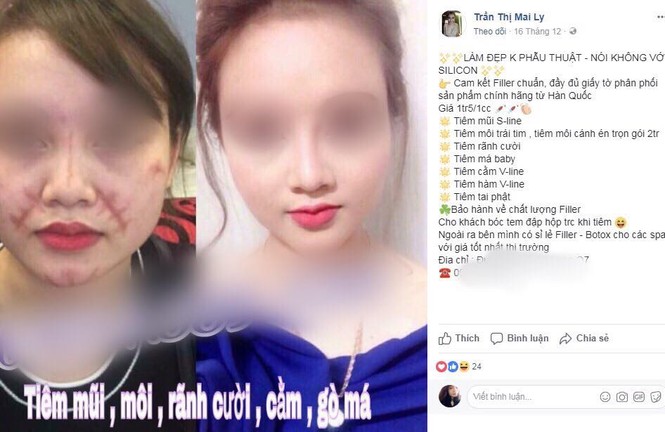 Tiêm filler: Sau công dụng 'thần tiên', làm nhanh giá rẻ là ẩn họa khôn lường! - ảnh 1
