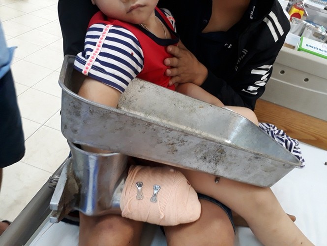 Người lớn lơ là, bé trai 3 tuổi bị máy xay thịt nghiền nát cánh tay - ảnh 1