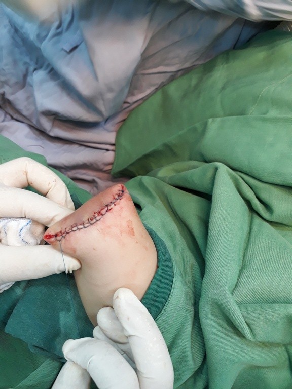 Người lớn lơ là, bé trai 3 tuổi bị máy xay thịt nghiền nát cánh tay - ảnh 2