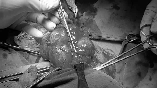 Cụ bà 74 tuổi mang khối bướu cổ gần 50 năm - ảnh 1