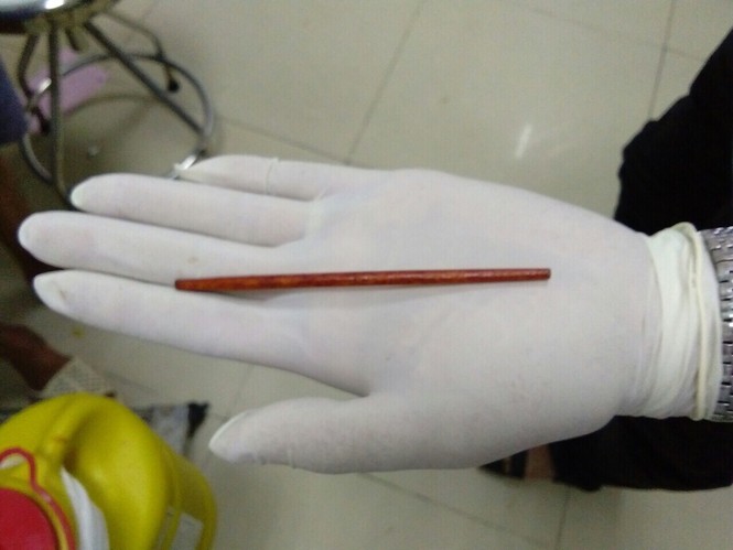 đũa dài trong niệu đạo - ảnh 1