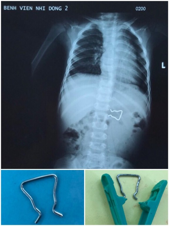 Nuốt móc sắt kẹp quần áo, bé trai 18 tháng suýt thủng ruột - ảnh 1