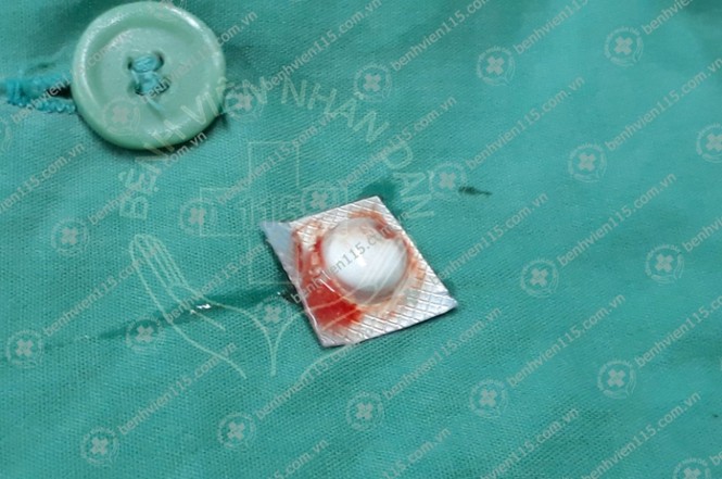 Phát hiện viên thuốc còn vỏ trong phế quản người đàn ông - ảnh 2