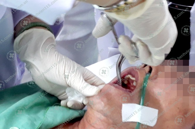 Phát hiện viên thuốc còn vỏ trong phế quản người đàn ông - ảnh 1