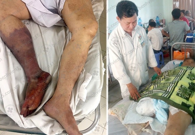 Cắt bỏ chân vì hoại tử do uống thuốc tim mạch không đều - ảnh 1