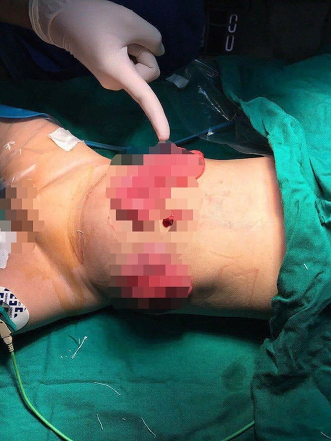 Bé 11 tháng tuổi bị mẹ ruột dùng dao đâm vào bụng - ảnh 1